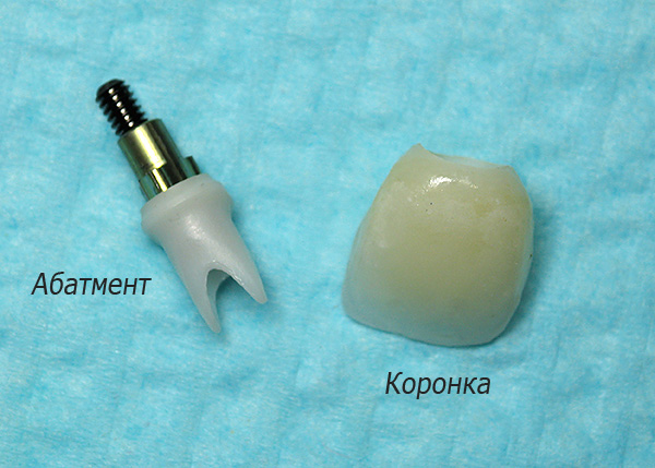 Een permanente bijdrage aan de totale kosten van protheses op implantaten wordt geleverd door het permanente abutment en de kroon.