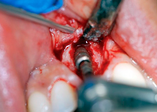 Zobu implanta noņemšana no žokļa ...