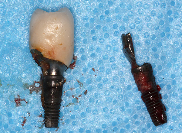 Helaas moeten tandheelkundige implantaten soms echt worden verwijderd.