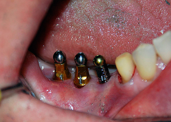 Životnosť aj tých najdrahších a vysoko kvalitných zubných implantátov môže byť veľmi malá, ak lekár pri ich inštalácii urobí chyby ...