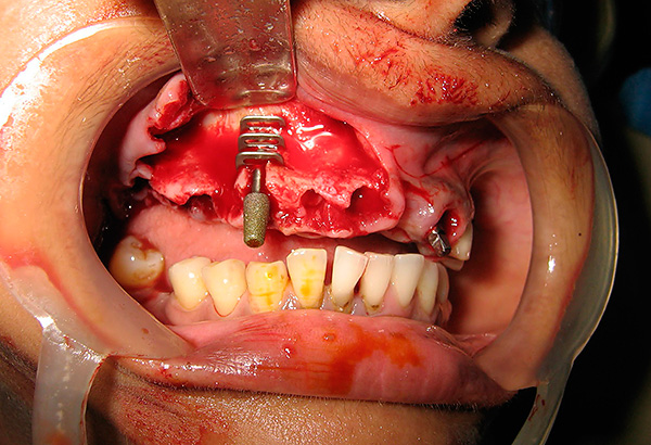 De foto toont een voorbeeld van het installeren van een verouderd basaal implantaat.