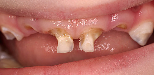 Carie des dents caduques