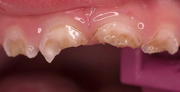 Senza un'adeguata cura orale, la situazione con i denti da latte può diventare rapidamente disastrosa ...