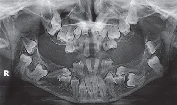 La posición anormal de los brotes de los dientes se puede detectar de antemano mediante una radiografía.
