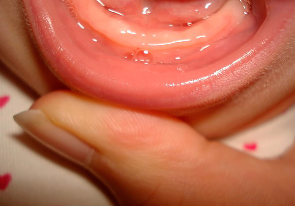 เหงือกของเด็กอายุประมาณ 4-6 เดือนของชีวิตมักปราศจากฟัน