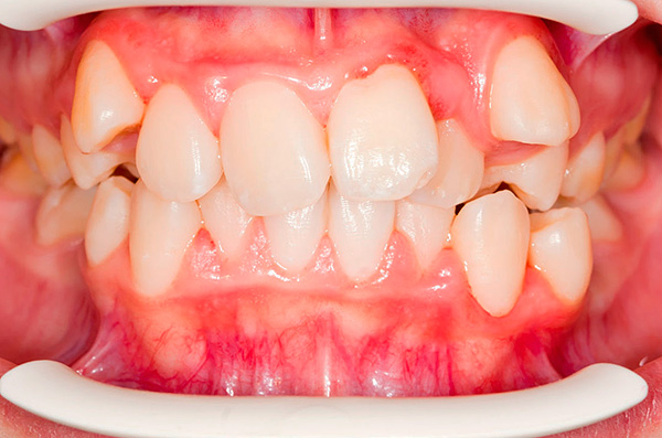 Distopia de les dents (la seva ubicació no està al seu lloc normal).
