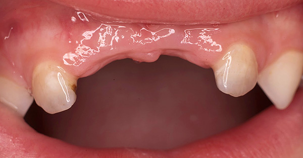 La perdita prematura dei denti primari può influire negativamente sullo sviluppo di un morso permanente in un bambino.