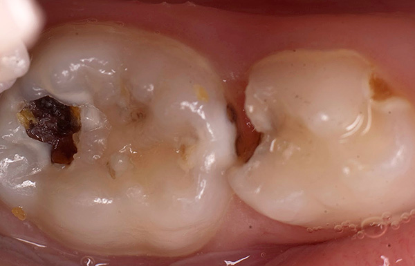 Bei vorzeitigem Verlust eines Kaumilchzahns können negative Veränderungen in der Position eines angrenzenden Zahns sowie eines Antagonisten am gegenüberliegenden Kiefer auftreten.
