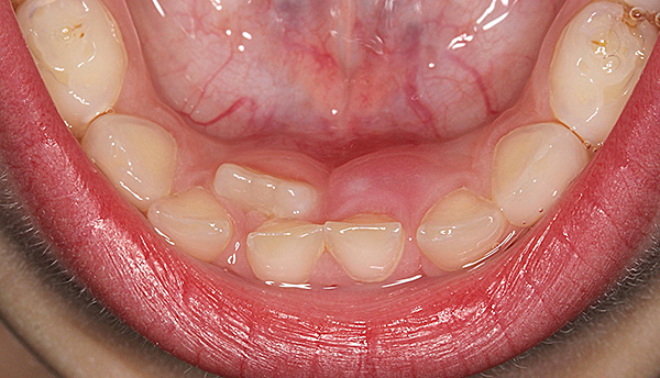Οδοντωτό δόντι στην κάτω σιαγόνα.