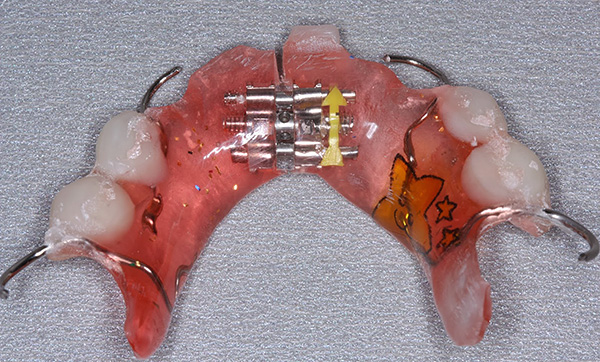 Ein Gerät mit einer Spreizschraube und künstlichen Zähnen zur Korrektur eines Milchbisses.