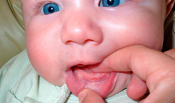 Biasanya gigi cecair yang lebih rendah adalah yang pertama meletus - pada masa ini kanak-kanak mungkin menjadi murung, kadang-kadang suhu badan meningkat.