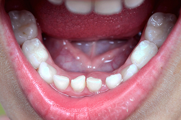 Na spodní čelisti (a stejné číslo na horním konci) je 10 zubů v plném mlékovém skusu.