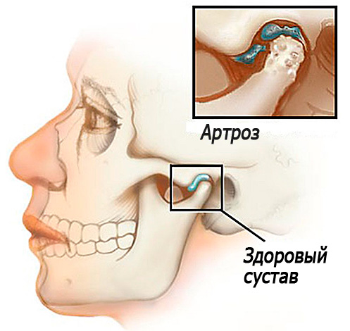 Resim şematik olarak temporomandibular eklemin artrozunu göstermektedir ...