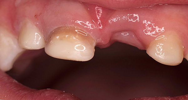 Ein früher Verlust der Milchzähne führt häufig zu einem Fehlschluss, da benachbarte Zähne beginnen, sich in Richtung des leeren Raums in der Reihe zu verschieben.