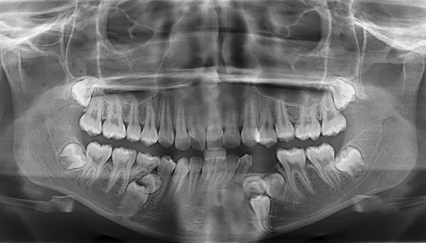 Un ortopantomograma ajuda un ortodontista amb el diagnòstic de diverses maloclusions.