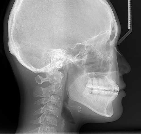Röntgenfoto van de schedel