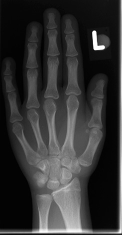 Met een röntgenfoto van de hand van het kind kunt u beoordelen of de ontwikkeling van zijn botten als geheel normaal is.