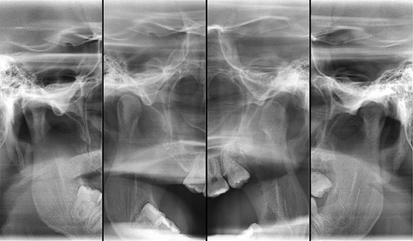 TMJ'nin röntgeni.