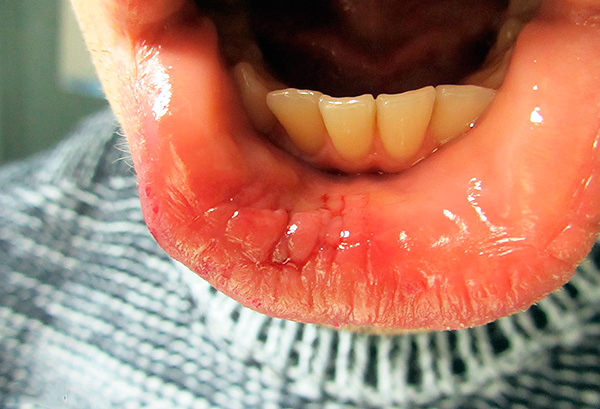 Постоянното ухапване на бузата или устната е опасно поради възможността от злокачествена формация върху увредената зона на лигавицата.