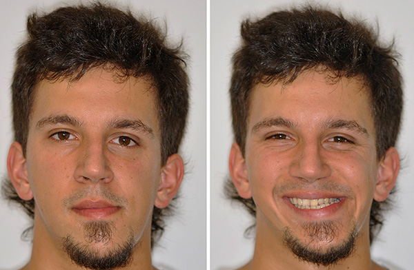 Afwijkingen van de occlusie worden vaak geassocieerd met enige asymmetrie van het gezicht.