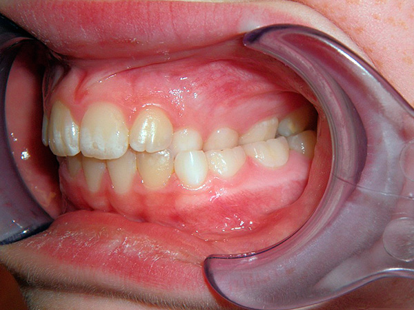 في بعض الأحيان تتقاطع الأسنان فقط في المنطقة الجانبية ...