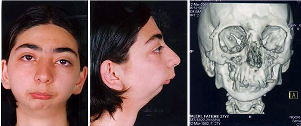 Utseende av en patient med TMJ-ankylos.