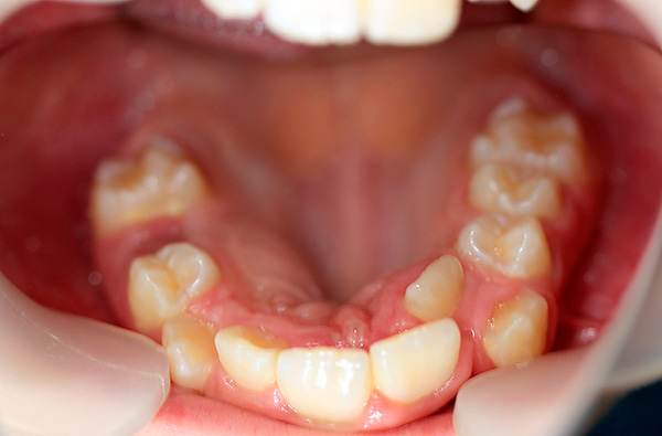 La violation du moment et de la séquence de la dentition peut également affecter la morsure pas pour le mieux.