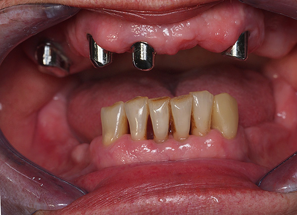 Clinical situation before prosthetics - metal crowns are installed on the preserved teeth of the upper jaw.