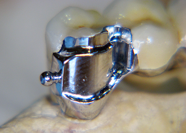 Part of the lock is located on the crown mounted on the tooth.