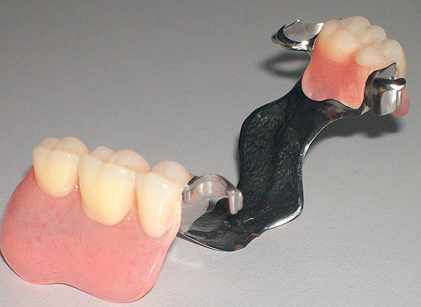 Esta es la prótesis de cierre en las cerraduras (en la mandíbula superior).