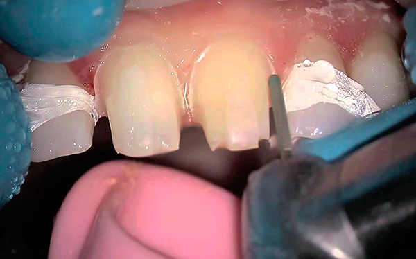 Un dezavantaj semnificativ al protezei de blocare pe încuietori este nevoia de a roti dinții de susținere sub coroane.
