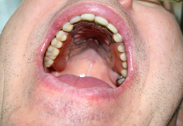 Som du ser ser låseprotesen i mundhulen ganske pæn ud - og det er ikke dens eneste fordel.