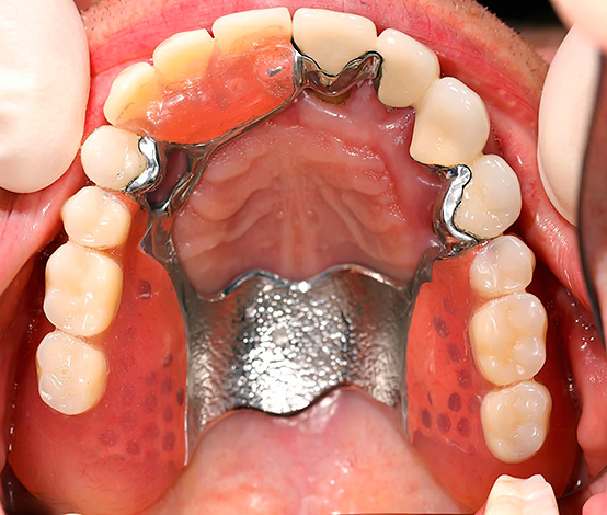 Un ejemplo de una prótesis de cierre montada en la mandíbula superior.