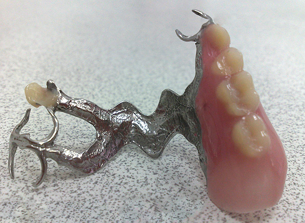 Ang arko ng metal ng prosthesis ay inuulit ang kaluwagan ng kalangitan, kaya naiiba ang hitsura nito sa bawat produkto.