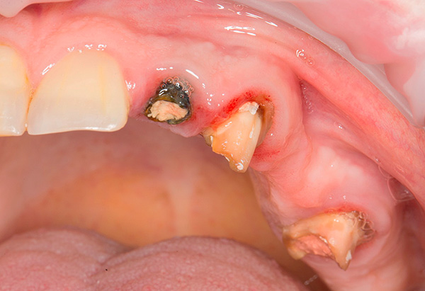 Før protetikproceduren kan nogle tænder (eller deres rester) muligvis fjernes.