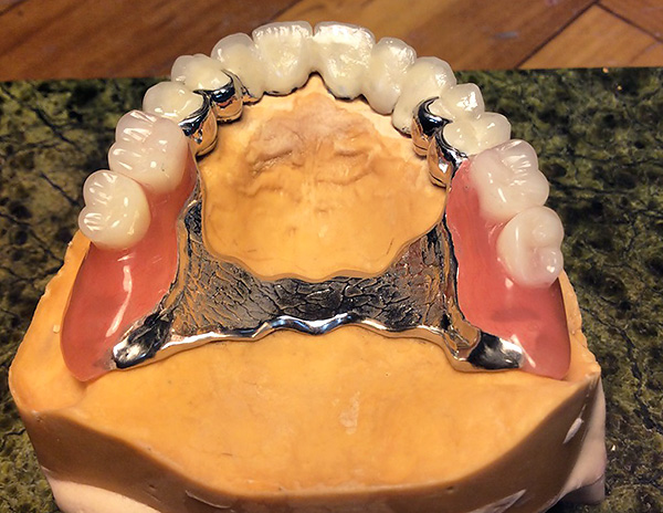 Fotografia prezintă un exemplu de proteză închisă finisată montată pe un model al maxilarului superior al pacientului.