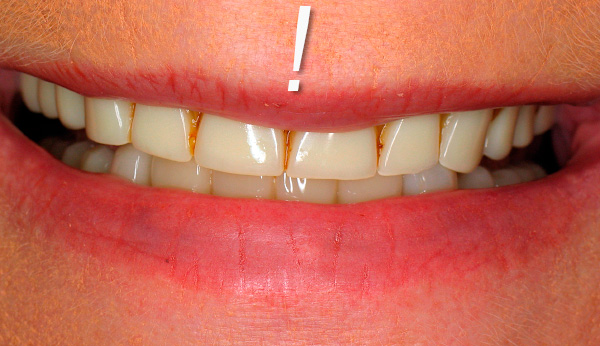 من المهم أن تضع في اعتبارك أنه يجب الاعتناء بأطقم الأسنان بانتظام ، حيث يمكن أن تتراكم عليها أيضًا البلاك.