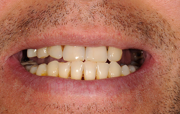 ליקויים מרובים בשיניים השיניים (במיוחד פגמי קצה) הם אחד האינדיקציות להתקנת תותבת אבזם.