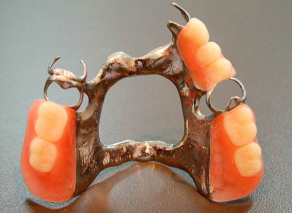 In seltenen Fällen können die Kunststoff- und Metallelemente der Prothese eine allergische Reaktion der Schleimhäute der Mundhöhle hervorrufen.