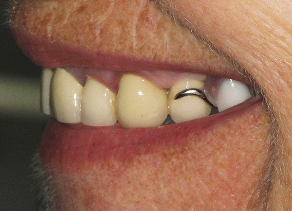 Unfortunately, in some cases, fastenings of the clasp prosthesis are visible with a smile.