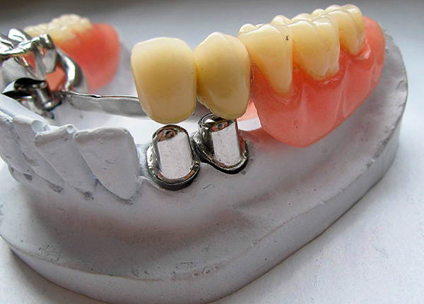 Clasp prosthesis on telescopic crowns.