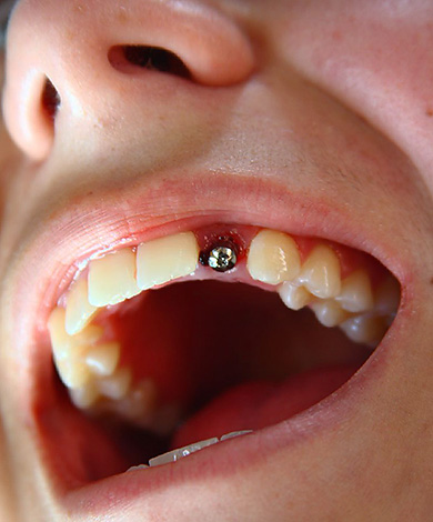 Fotoğraf, bir diş kaybı ile estetik açıdan önemli bir alana bir Alfa BIO implantının kurulumunun bir örneğini göstermektedir.