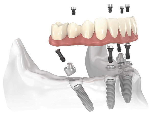 Dantų protezavimo įdiegimo schema „Viskas ant 4“.