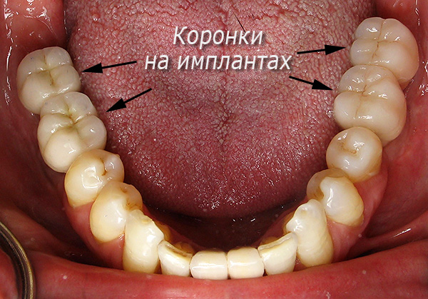 Kauen von Zahnprothesen auf Implantaten Alpha BIO