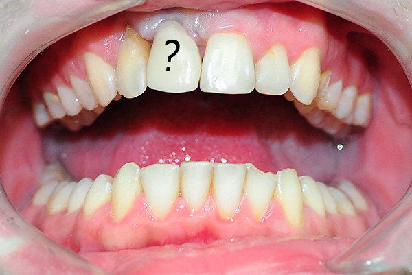 With insufficient oral hygiene, inflammation in the area of ​​the installed implant may begin.