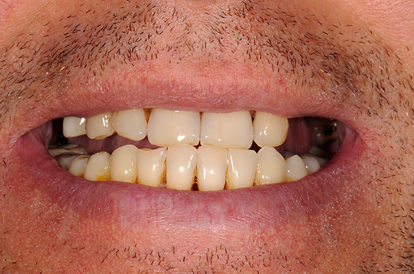 Снимката показва състоянието на зъбите на пациента преди лечение с протези на импланти.