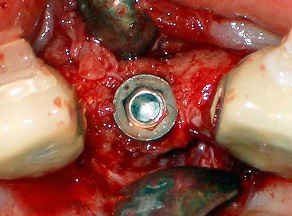 Implantát Alpha BIO v čelisti - jamka ve tvaru šestiúhelníku (pod podpěrou) je jasně viditelná.