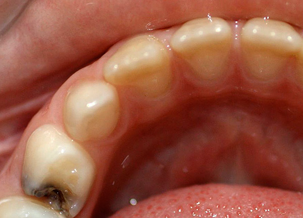 ในกรณีที่มีอาการปวดเฉียบพลันในฟันขอแนะนำให้รีบไปรับการดูแลทันตกรรมฉุกเฉิน
