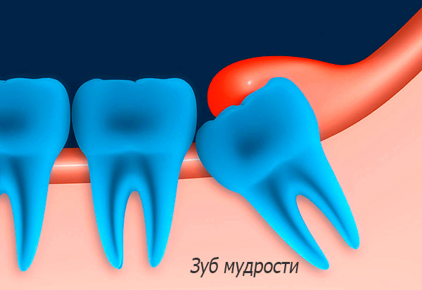 The picture schematically shows a difficult erupting wisdom tooth.