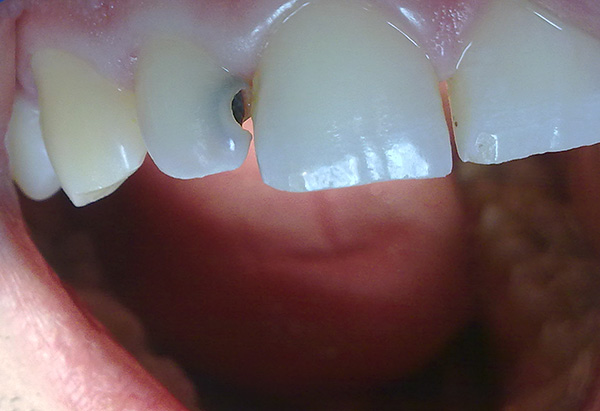 Det viktigaste är inte att använda smärtstillande medel som ett alternativ till att besöka tandläkaren.